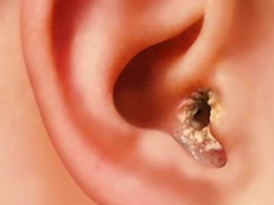 SWIMMER'S EAR AND THE BEST WAYS TO TREAT IT